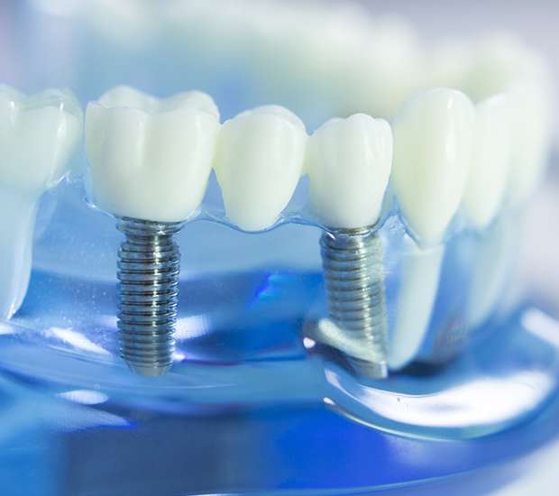 Rockville Dental Implants